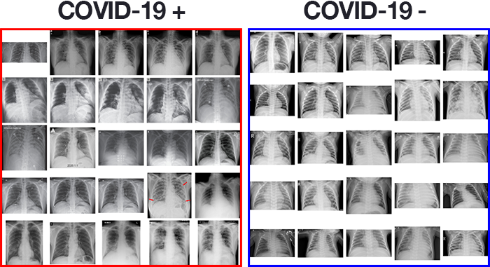 <a href="https://www.pyimagesearch.com/2020/03/16/detecting-covid-19-in-x-ray-images-with-keras-tensorflow-and-deep-learning/" target="_blank" rel="nofollow noopener">Source</a>
